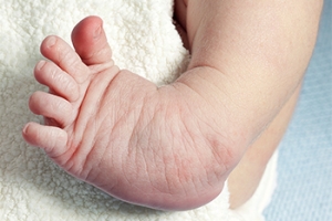 Treatment of Clubfoot