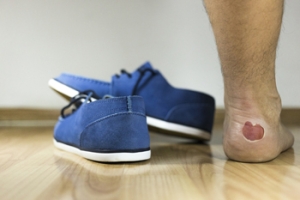 Dealing With Blisters While Running