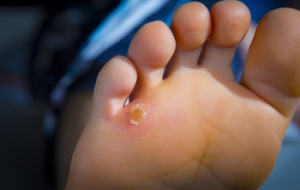 Possible Reasons Why Corns Develop