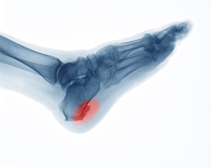 Causes and Treatment of Heel Spurs