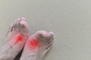 Gout Is Painful