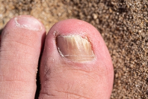 Facts About Toenail Fungus