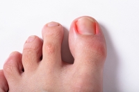 Poorly Fitting Shoes May Cause Ingrown Toenails