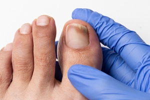 Various Types of Toenail Fungus